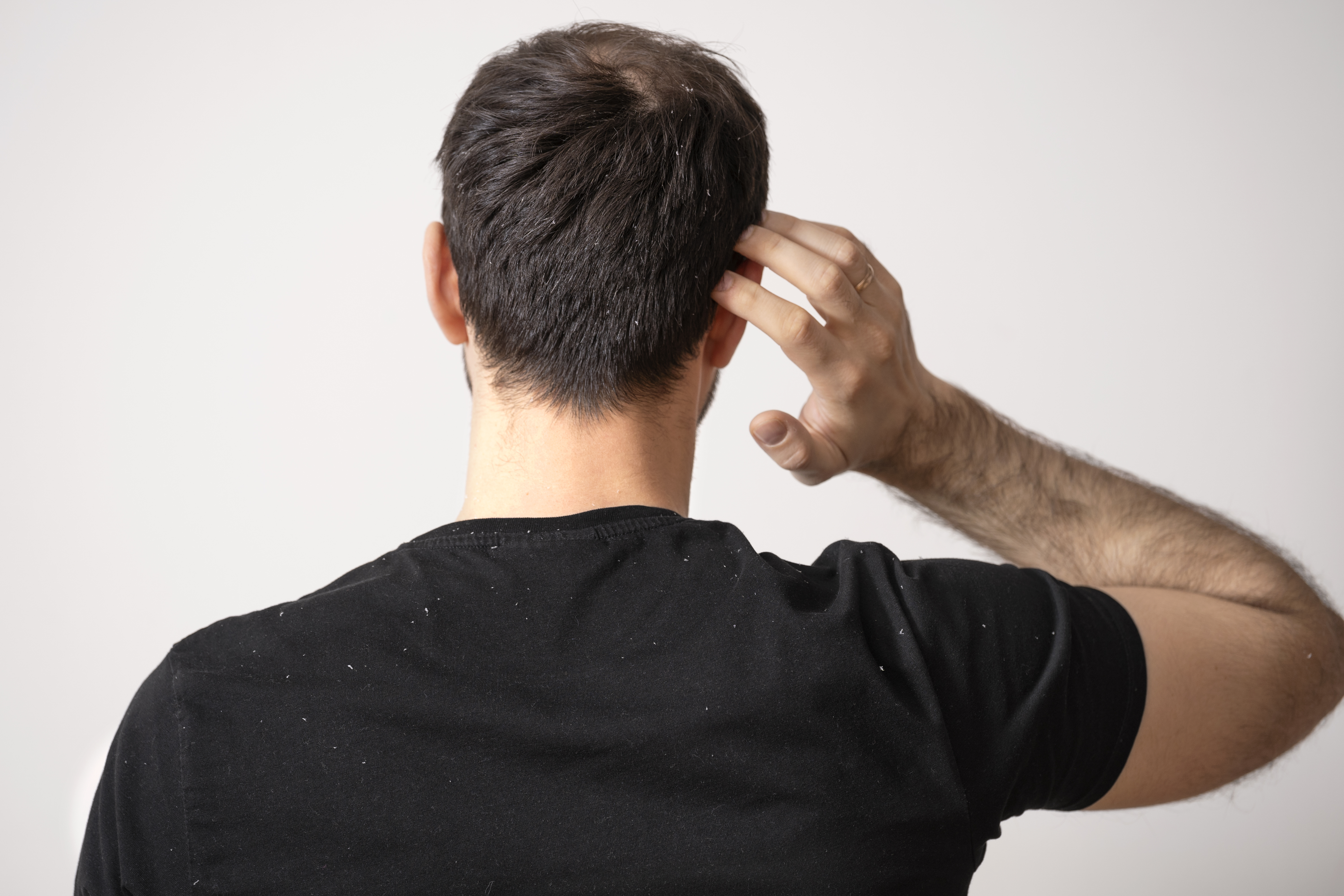 Why Your Dandruff Keeps Coming Back & How Dermatologists Treat It