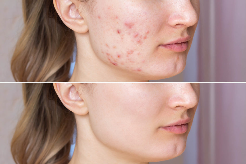 before after acne treatment face