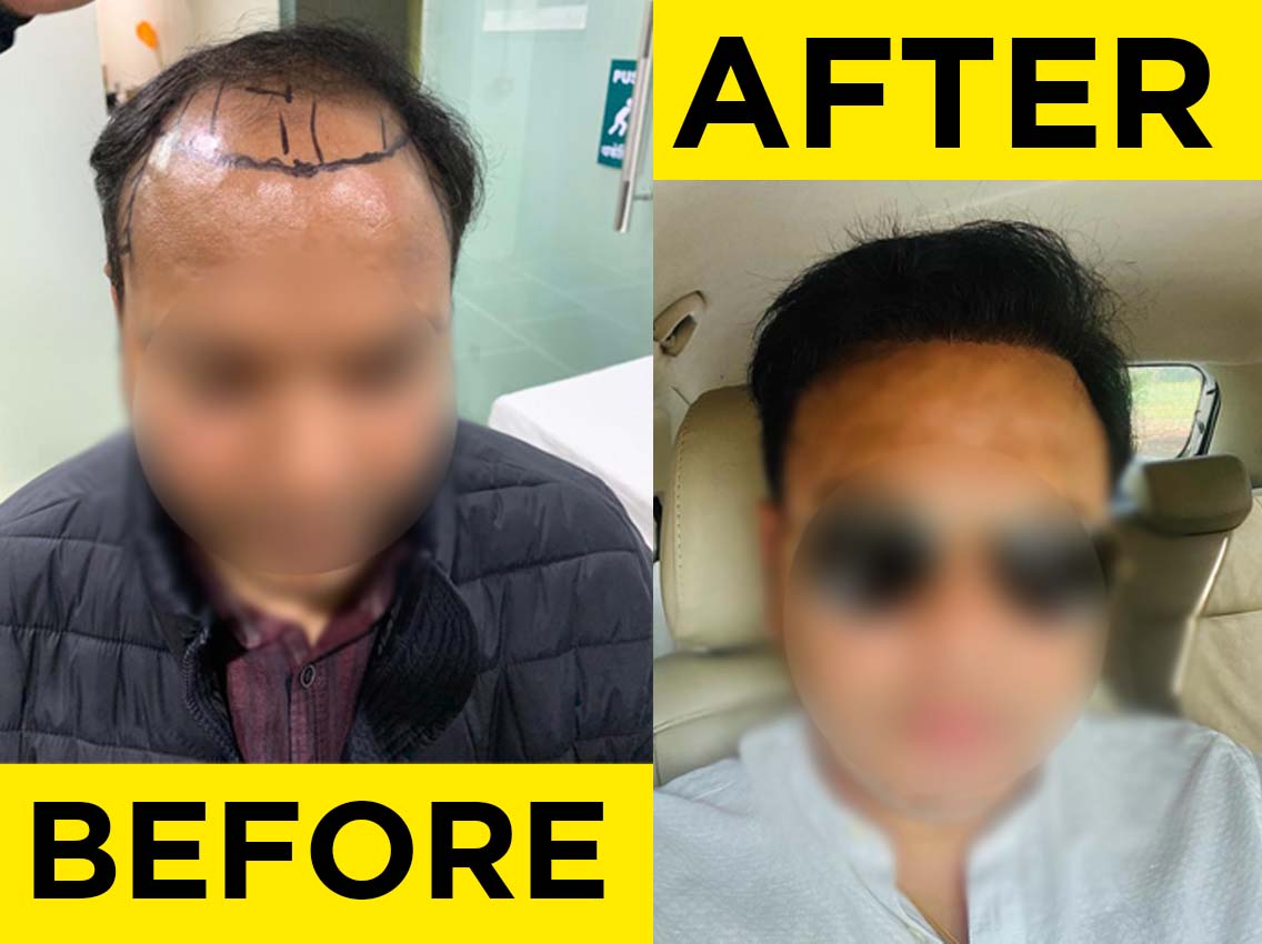 before after hair transplant