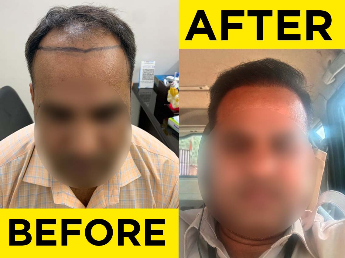 before after hair transplant1