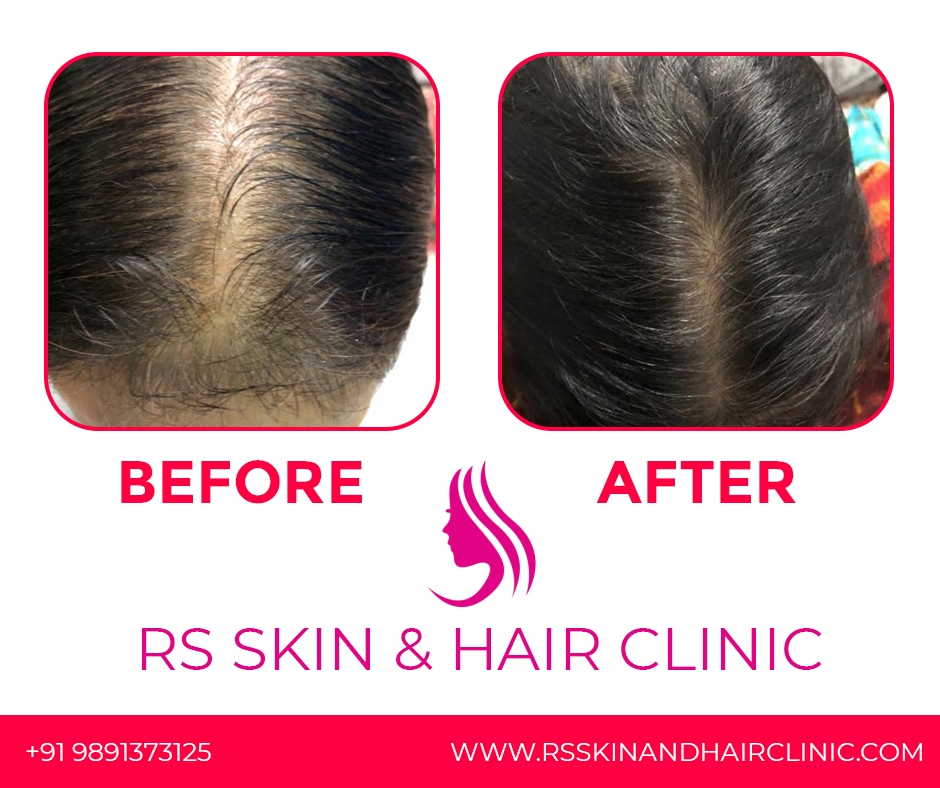 Best Hair Transplant and Laser Hair Reduction Services in Rohini