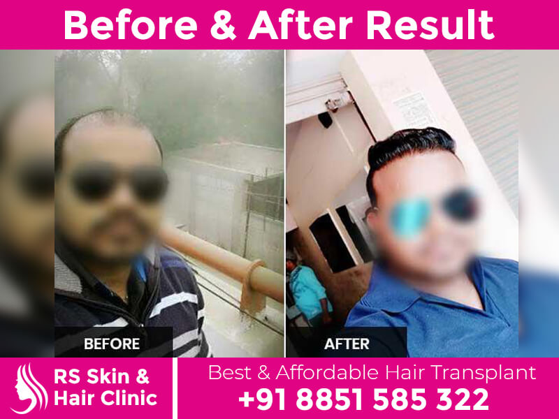 Hair Transplant In Rohini Delhi | Affordable and Best Service