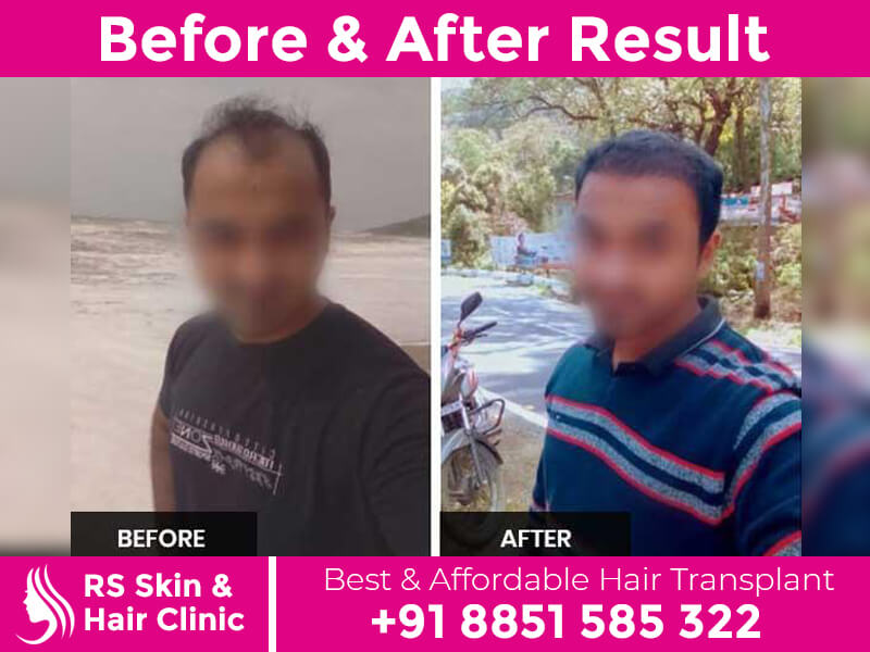 Hair Transplant In Rohini Delhi | Affordable and Best Service