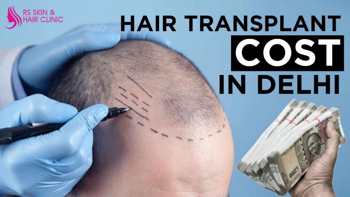 Hair Transplant Cost In Delhi | Full Details Min to Max Price
