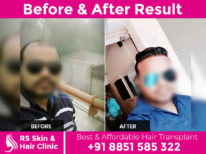 before-after-hair-transplant-23