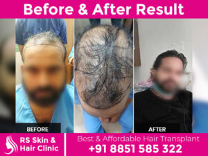 before-after-hair-transplant-3