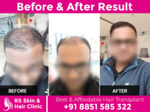 before-after-hair-transplant_22