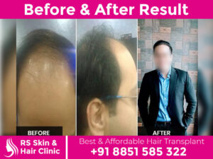 before-after-hair-transplant-4