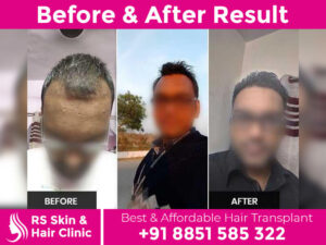 before-after-hair-transplant-5