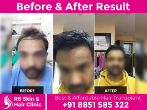 before-after-hair-transplant-6