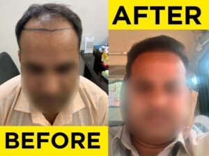 before-after-hair-transplant1