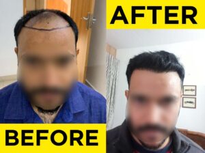 before-after-hair-transplant2