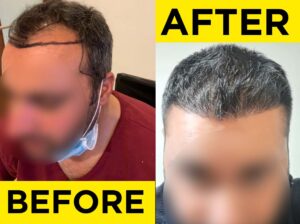 before-after-hair-transplant3-1