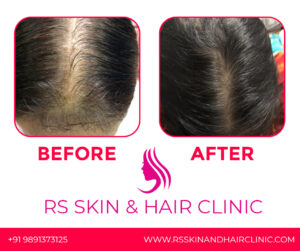 before-after_rsskinandhairclinic